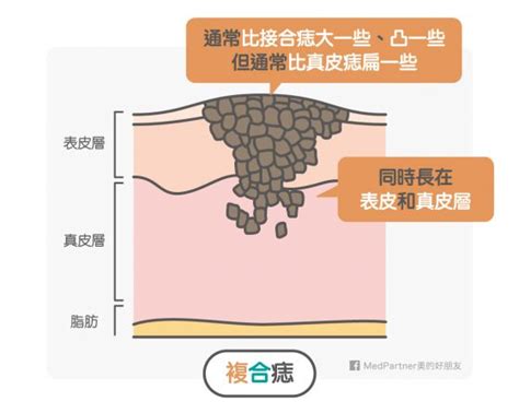 觀音痣女|美人痣、三八痣、觀音痣，痣怎麼來的又該如何消去？。